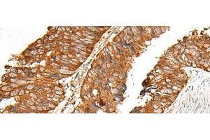 Immunohistochemistry of paraffin-embedded Human colorectal cancer tissue using MBOAT4 Polyclonal Antibody at dilution of 1:30(x200) (MBOAT4 抗体)
