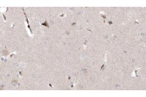 ABIN6273005 at 1/100 staining Human brain cancer tissue by IHC-P. (MAGT1 抗体  (Internal Region))