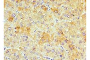 Immunohistochemistry of paraffin-embedded human liver cancer using ABIN7153637 at dilution of 1:100