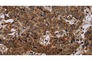 Immunohistochemistry of paraffin-embedded Human liver cancer using SLC1A6 Polyclonal Antibody at dilution of 1:40