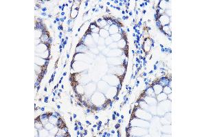 Immunohistochemistry of paraffin-embedded Human colon carcinoma using /// Rabbit pAb (ABIN7265627) at dilution of 1:50 (40x lens). (ANT1+ANT2+ANT3+ANT4 (C-Term) 抗体)