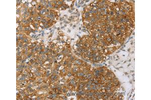 Immunohistochemistry of Human breast cancer using TPD52L2 Polyclonal Antibody at dilution of 1:35 (TPD52L2 抗体)