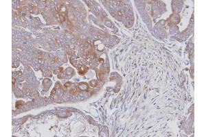 IHC-P Image Immunohistochemical analysis of paraffin-embedded N87 xenograft, using MAPK9, antibody at 1:100 dilution. (JNK2 抗体)