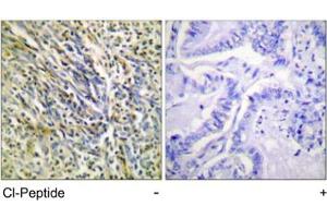 Immunohistochemical analysis of paraffin-embedded human lung carcinoma tissue using ACAN polyclonal antibody . (Aggrecan 抗体  (AA 336-369))