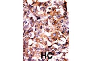 Formalin-fixed and paraffin-embedded human cancer tissue reacted with the primary antibody, which was peroxidase-conjugated to the secondary antibody, followed by AEC staining. (MAPKAP Kinase 2 抗体  (pSer272))