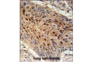 C4orf31 Antibody (N-term) (ABIN651996 and ABIN2840488) immunohistochemistry analysis in formalin fixed and paraffin embedded human lung carcinoma followed by peroxidase conjugation of the secondary antibody and DAB staining. (NDNF 抗体  (AA 80-109))