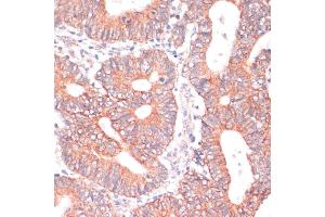 Immunohistochemistry of paraffin-embedded human colon carcinoma using TI antibody (ABIN6130725, ABIN6149146, ABIN6149147 and ABIN6214431) at dilution of 1:100 (40x lens). (TIAM1 抗体  (AA 1392-1591))