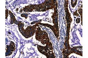 ABIN7094633 and ABIN7098683 at 1/100 staining Human liver cancer by IHC-P. (PGAM2 抗体  (Internal Region))