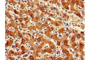 Immunohistochemistry of paraffin-embedded human liver cancer using ABIN7152571 at dilution of 1:100 (FDPS 抗体  (AA 1-419))