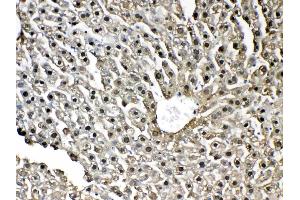 IHC analysis of GST3 / GST pi using anti-GST3 / GST pi antibody . (GSTP1 抗体  (AA 2-210))