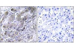 Immunohistochemistry analysis of paraffin-embedded human liver carcinoma tissue, using MRPS18A Antibody. (MRPS18A 抗体  (AA 81-130))