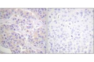 Immunohistochemistry analysis of paraffin-embedded human breast carcinoma tissue, using p130 Cas (Ab-165) Antibody. (BCAR1 抗体  (AA 131-180))