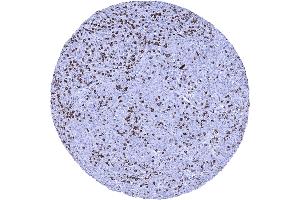 Squamous cell carcinoma containing numerous CD8 positive tumor infiltrating lymphocytes (Recombinant CD8 抗体  (AA 135-235))