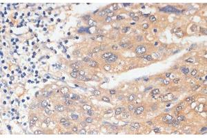 Immunohistochemistry of paraffin-embedded Human liver cancer using WNK3 Polyclonal Antibody at dilution of 1:100 (40x lens). (WNK3 抗体)