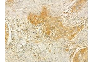 ABIN6264496 and ABIN6277636 at 1/100 staining human tongue carcinoma by IHC-P.
