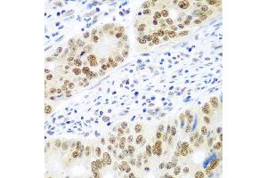 Immunohistochemistry of paraffin-embedded human colon carcinoma using MDC1 antibody at dilution of 1:100 (40x lens). (MDC1 抗体)