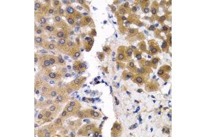 Immunohistochemistry of paraffin-embedded human liver cancer using SCP2 antibody. (SCP2 抗体)