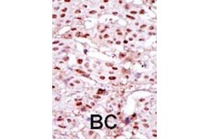 Formalin-fixed and paraffin-embedded human cancer tissue reacted with the primary antibody, which was peroxidase-conjugated to the secondary antibody, followed by DAB staining. (CSNK2A1/CK II alpha 抗体  (AA 240-269))