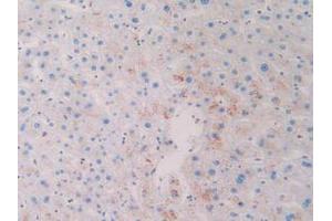 IHC-P analysis of Human Skin Cancer Tissue, with DAB staining. (CD63 抗体  (AA 103-203))