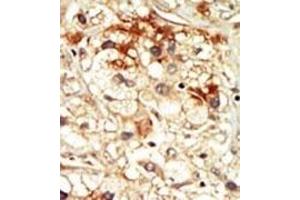 Formalin-fixed and paraffin-embedded human cancer tissue reacted with the primary antibody, which was peroxidase-conjugated to the secondary antibody, followed by DAB staining. (CDK17 抗体  (N-Term))