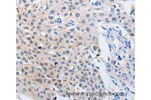 Immunohistochemistry of Human lung cancer using YWHAQ Polyclonal Antibody at dilution of 1:50 (14-3-3 theta 抗体)