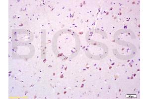 Formalin-fixed and paraffin embedded human glioma tissue labeled with Anti-CYP3A4 Polyclonal Antibody, Unconjugated (ABIN733793) at 1:200 followed by conjugation to the secondary antibody and DAB staining (CYP3A4 抗体  (AA 18-120))