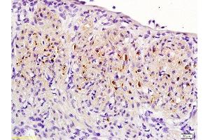 Formalin-fixed and paraffin embedded: rat uterine myoma labeled with Anti-PR (progesterone receptor) Polyclonal Antibody , Unconjugated 1:200 followed by conjugation to the secondary antibody and DAB staining (Progesterone Receptor 抗体  (AA 501-600))