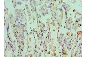 Immunohistochemistry of paraffin-embedded human lung cancer using ABIN7152105 at dilution of 1:100 (EIF4A1 抗体  (AA 167-406))