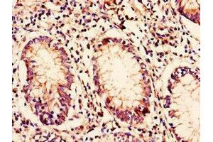 Immunohistochemistry of paraffin-embedded human colon cancer using ABIN7145632 at dilution of 1:100 (C10ORF32 抗体  (AA 2-105))