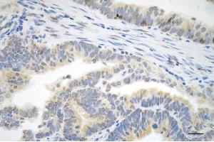 Immunohistochemistry was performed on paraffin-embedded human endometrial carcinoma using P70 S6 kinase beta antibody (ABIN7800226), 1:200). (Recombinant RPS6KB2 抗体)