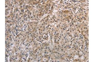 The image on the left is immunohistochemistry of paraffin-embedded Human gastic cancer tissue using ABIN7129403(ESRRG Antibody) at dilution 1/30, on the right is treated with fusion protein. (ESRRG 抗体)