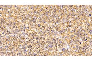 Detection of ATP1a1 in Human Ovarian cancer Tissue using Monoclonal Antibody to ATPase, Na+/K+ Transporting Alpha 1 Polypeptide (ATP1a1) (ATP1A1 抗体  (AA 493-660))