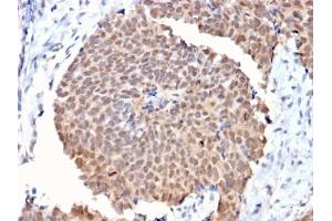Formalin-fixed, paraffin-embedded human Breast Cancer stained with FAF1 Mouse Monoclonal Antibody (CPTC-FAF1-2). (FAF1 抗体)