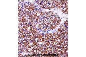 BAG2 Antibody (C-term) ((ABIN657974 and ABIN2846920))immunohistochemistry analysis in formalin fixed and paraffin embedded human ovarian carcinoma followed by peroxidase conjugation of the secondary antibody and DAB staining. (BAG2 抗体  (C-Term))