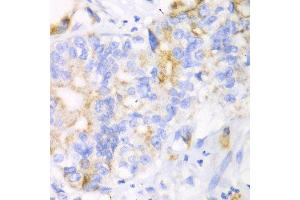 Immunohistochemistry of paraffin-embedded human liver cancer using CHIA antibody at dilution of 1:100 (x40 lens). (CHIA 抗体)