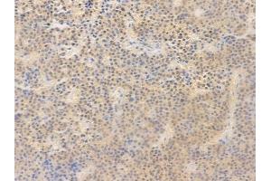 ABIN6255115 and ABIN6267636 at 1/100 staining human pituitary adenoma by IHC-P. (G3BP1 抗体  (pSer232))