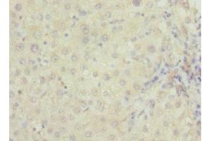 Immunohistochemistry of paraffin-embedded human liver cancer using ABIN7167252 at dilution of 1:100 (RAB23 抗体  (AA 1-237))