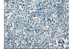 Immunohistochemical staining of paraffin-embedded Adenocarcinoma of ovary tissue using anti-PORmouse monoclonal antibody. (POR 抗体)