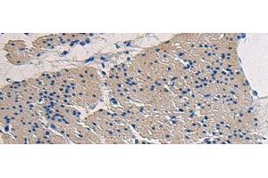 Immunohistochemistry of paraffin-embedded Human gastric cancer tissue using COL17A1 Polyclonal Antibody at dilution of 1:50(x200) (COL17A1 抗体)