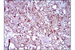 Immunohistochemical analysis of paraffin-embedded cervical cancer tissues using SYCP3 mouse mAb with DAB staining. (SYCP3 抗体  (AA 27-128))