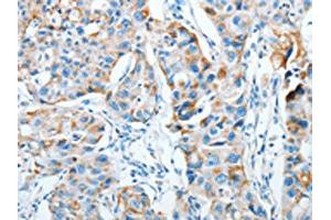 The image on the left is immunohistochemistry of paraffin-embedded Human breast cancer tissue using ABIN7128282(AGA Antibody) at dilution 1/20, on the right is treated with fusion protein. (AGA 抗体)