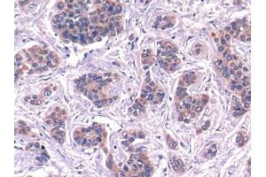 DAB staining on IHC-P; Samples: Human Liver cancer Tissue (Complement C4 抗体  (AA 975-1336))
