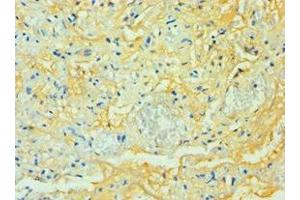 Immunohistochemistry of paraffin-embedded human lung tissue using ABIN7171585 at dilution of 1:100 (TTBK2 抗体  (AA 1185-1244))