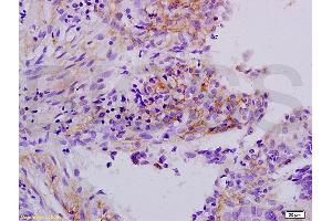 Formalin-fixed and paraffin embedded human laryngeal cancer labeled with Anti-APOH Polyclonal Antibody, Unconjugated (ABIN731483) at 1:200 followed by conjugation to the secondary antibody and DAB staining. (APOH 抗体  (AA 281-345))