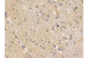 ABIN6255430 and ABIN6267624 at 1/100 staining human glioblastoma by IHC-P.