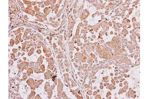 IHC-P Image ARA9 antibody [N1C3] detects ARA9 protein at cytoplasm on human lung carcinoma by immunohistochemical analysis.