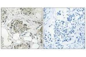 Immunohistochemistry analysis of paraffin-embedded human breast carcinoma tissue, using USP13 antibody. (USP13 抗体)