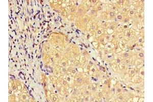 Immunohistochemistry of paraffin-embedded human liver cancer using ABIN7151414 at dilution of 1:100 (EFCAB7 抗体  (AA 1-158))