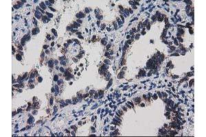 Immunohistochemical staining of paraffin-embedded Carcinoma of Human thyroid tissue using anti-HDHD1A mouse monoclonal antibody. (HDHD1 抗体)