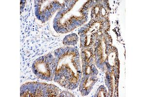 Anti-Hydroxysteroid(17-beta) Dehydrogenase 4 antibody, IHC(P) IHC(P): Human Intestinal Cancer Tissue
